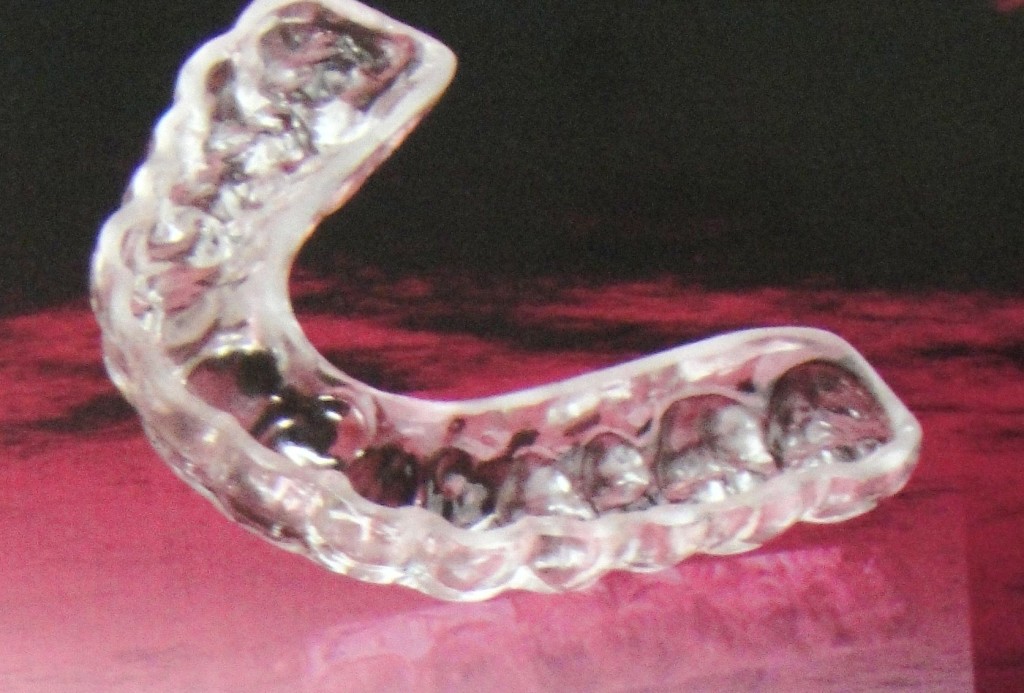 Occlusal mouthguard
